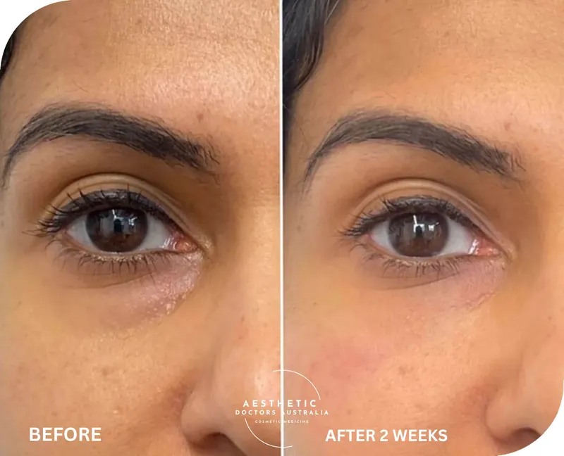 Close before and after composite of polynucleotide treatment showing smoother, brighter under-eye skin