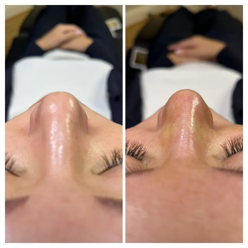 Before and after composite of the nasal tip viewed from below following PDO nose thread treatment