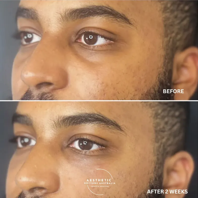 Before and after composite of a male patient showing reduced under-eye hollowing on upward gaze two weeks after treatment