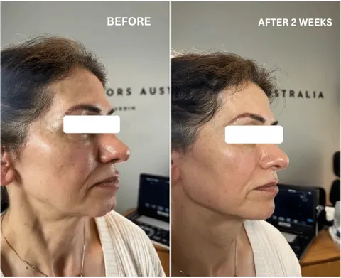 Before and after composite showing the mid and lower face treated with volume enhancement to restore contour
