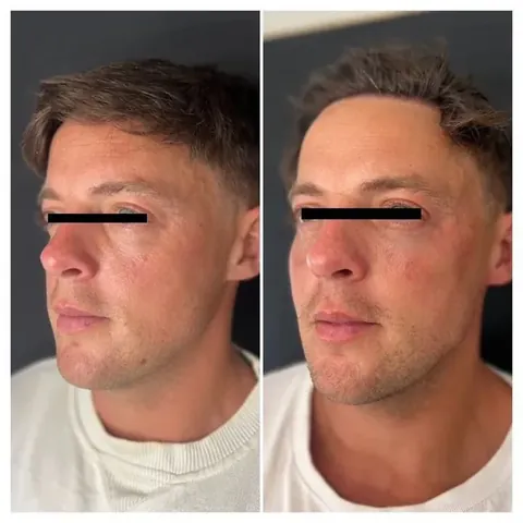 Before and after composite of cheek volume enhancement for a male patient showing restored mid-face support