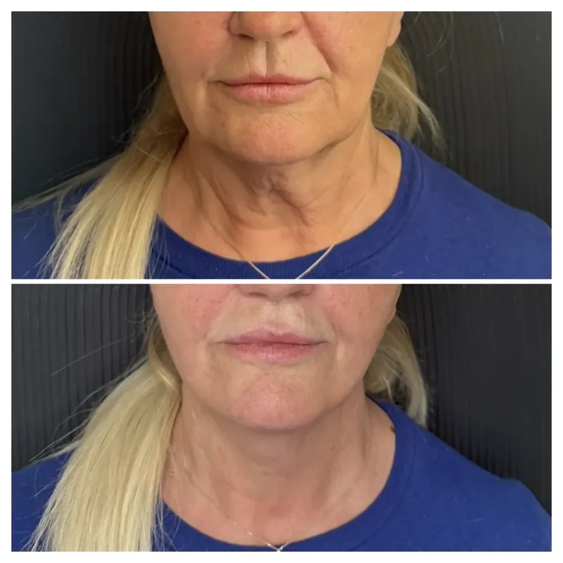 Before and after composite of neck rejuvenation showing smoother neck skin and softer horizontal lines