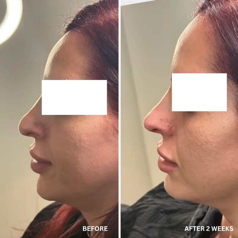 Before and after composite of non-surgical rhinoplasty showing a straighter profile line over the bridge