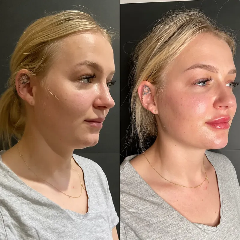 Before and after composite in three-quarter view following full face rejuvenation, with the cheek, jawline and lips treated together