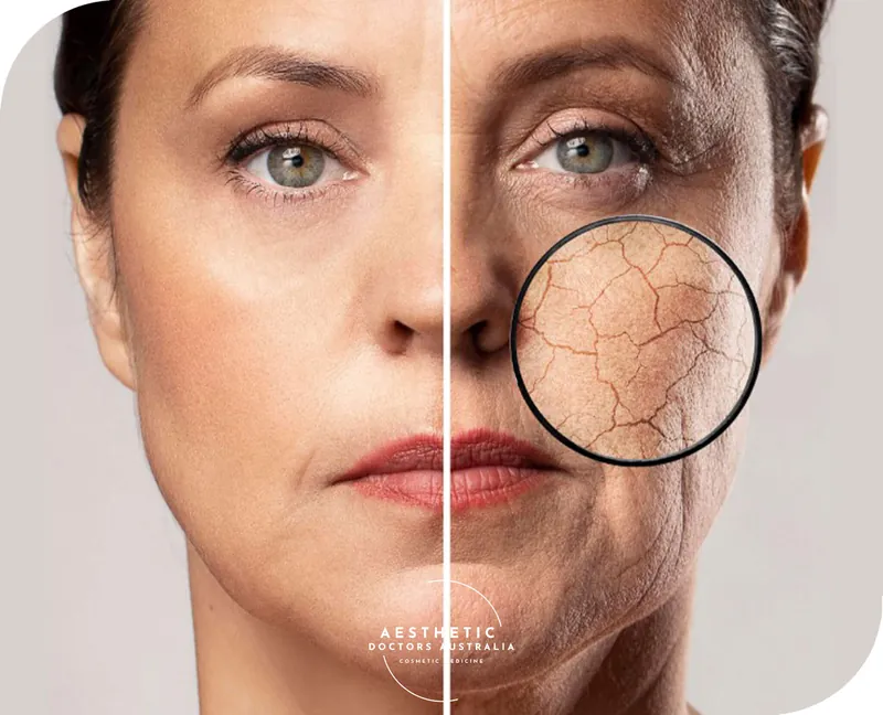 Hyperdilute Collagen Biostimulator skin-quality treatment at Aesthetic Doctors Australia