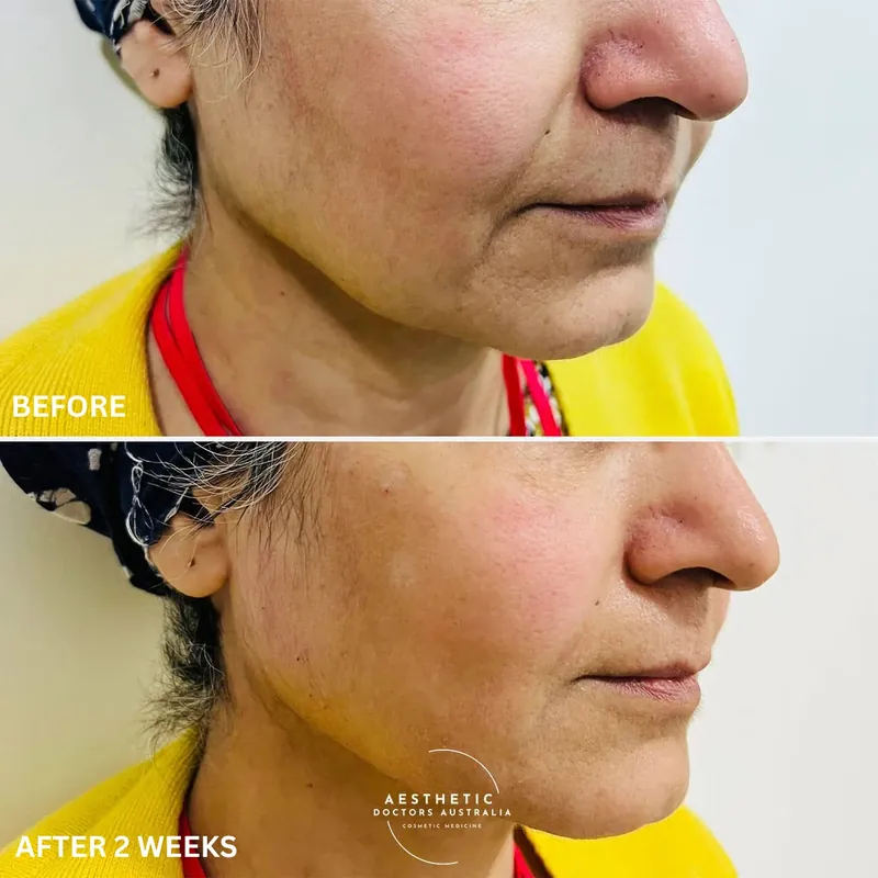 Before and after composite showing the smile line and marionette line treated with volume enhancement