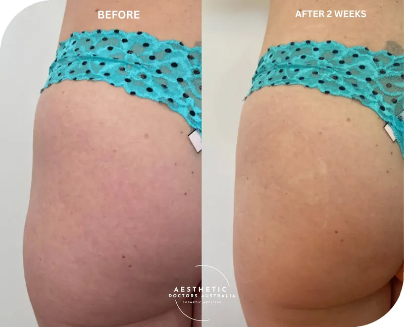 Before and after composite of hip dip treatment showing a smoother outer-hip contour two weeks after treatment