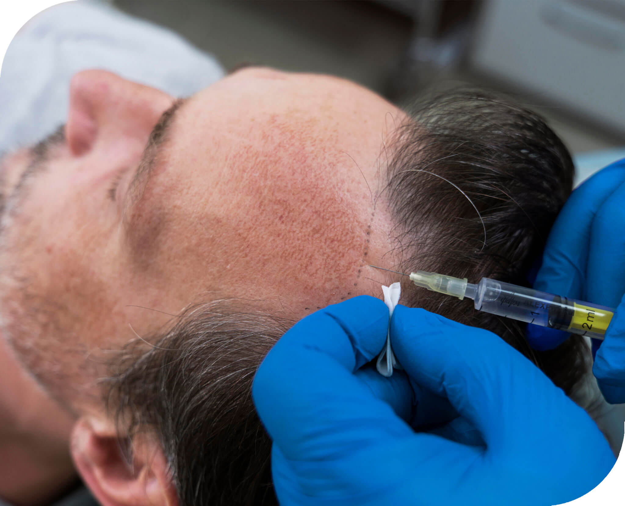 Injection placed along the hairline during a platelet-rich treatment for thinning hair