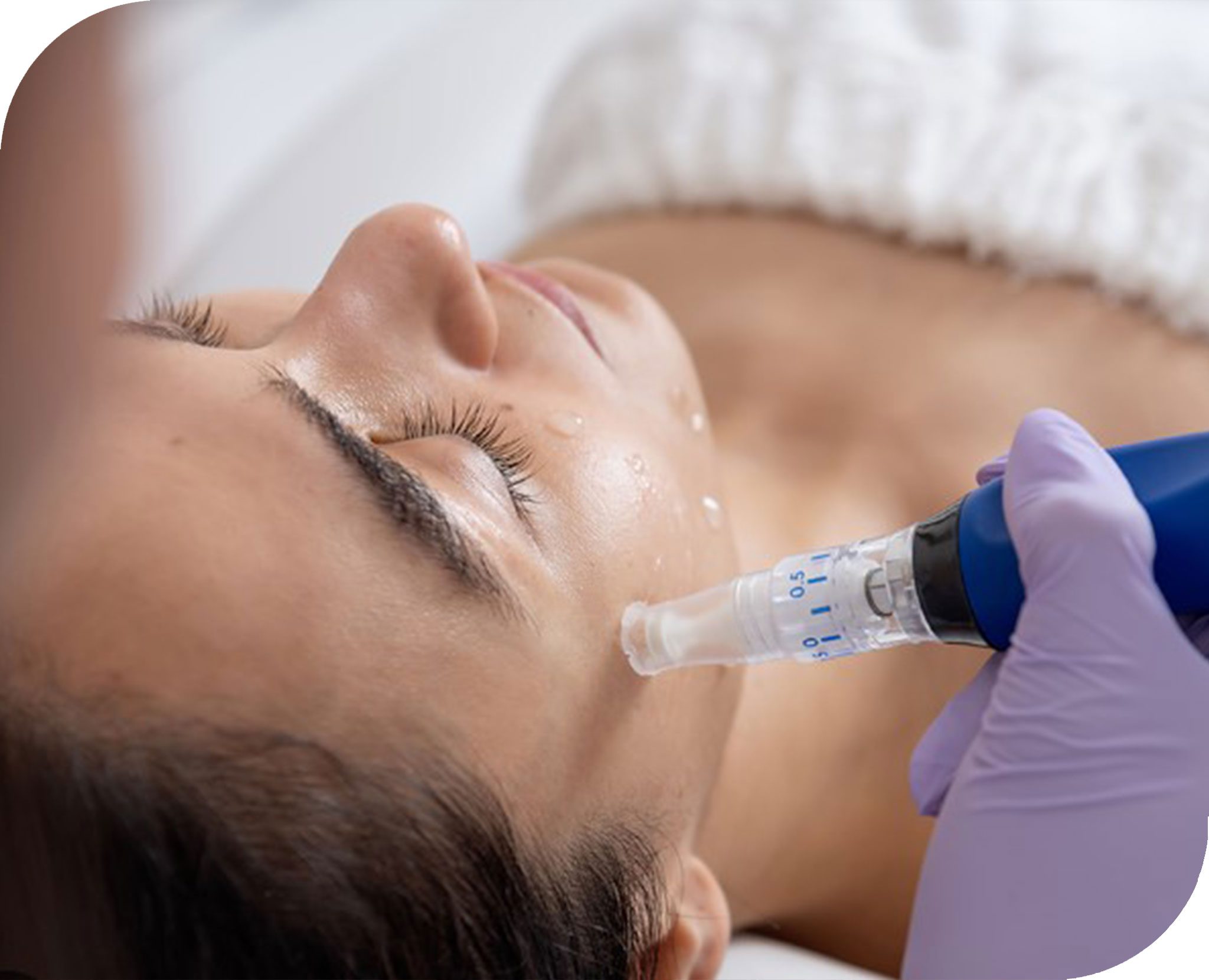 A microneedling handpiece passing over the cheek during treatment